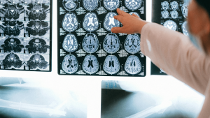 brain tumor